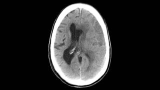 Subdural Hematoma  Before amp After [upl. by Llerat]