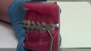 How to fix a loose wire from braces Orthodontic emergency [upl. by Briny]