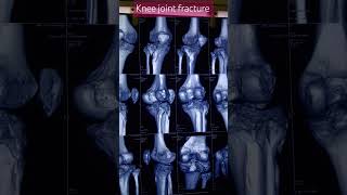 Knee joint 3D fracture  trauma patient  ct scan knee knee trending ctscan 3d fracture [upl. by Chadburn]