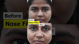 Nose Filler  Nose Filler cost shortvideo shorts [upl. by Hilten]