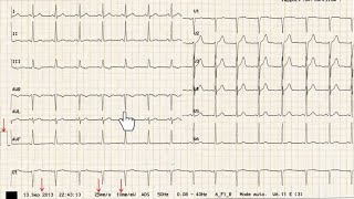 ECG de A à Z  exercice 1  correction [upl. by Haynor]