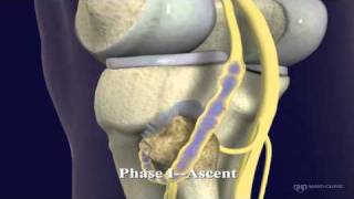 Peroneal and Tibial Intraneural Ganglion Cysts in the Knee Region Video 1 [upl. by Phip]