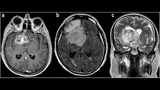 MRI Application training Brain without contrast [upl. by Esorylime]