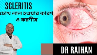 🔴 Scleritis Symptoms Treatment  চোখ লাল হওয়ার কারণ [upl. by Tan]