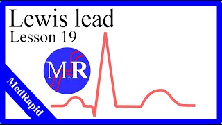 Lewis lead in EKG [upl. by Georges]