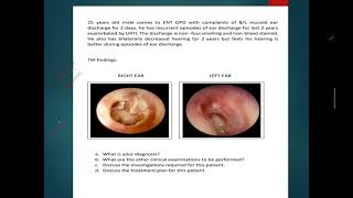 ENT MOCK CASE PRESENTATION  TUBOTYMPANIC TYPE  CSOM  MBBS [upl. by Lytsirhc]