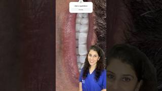 Treatment of Pyorrhoea  Tobacco stains  Zirconia crown viralvideo shorts smilemakeover smile [upl. by Phenice112]