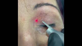 Xanthelasma removal with Co2 laser [upl. by Bonn]