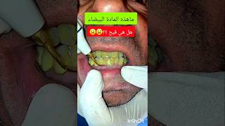 تقليح الاسنان teeth scaling dentist stitch اكسبلور stitchlover ترند [upl. by Nwahsirhc917]