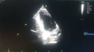 akinetic septum hypokinetic mid apical anterior and inferior wall moderate Lv [upl. by Gnaoh]