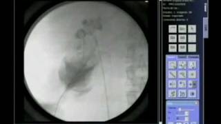 FLUOROSCOPY IN PERCUTANEUS RENAL SURGERY [upl. by Ettennan]