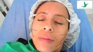 Hilos Absorbibles para Lifting Facial VLIFT [upl. by Greabe]