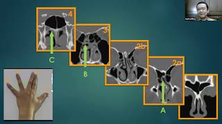 Paranasal Sinuses CT  A map toward safe endoscopic sinus surgery [upl. by Wini323]