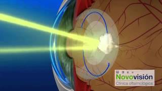 ¿CÓMO FUNCIONA EL LÁSER YAG  CLÍNICAS NOVOVISIÓN [upl. by Naesyar]