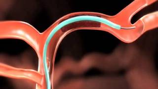 Solitaire™ FR Revascularization Device [upl. by Ennovart]