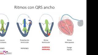 15  Taquicardia ventricular TV [upl. by Ettecul]