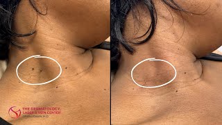 Skin Tag Removal  Dr Shalini Gupta [upl. by Kaleena]