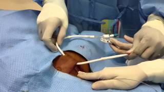 Tunneled Dialysis Catheter Insertion [upl. by Animor681]