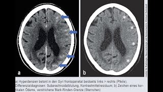 Kontrastmittelinduzierte Enzephalopathie [upl. by Ahsaei]