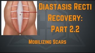 Diastasis Recti Recovery Part 22  Mobilizing Scars [upl. by Japheth380]