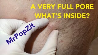 Very full pore Let’s see what’s inside Do you think it’s just a clogged pore or is there a sac [upl. by Naol989]