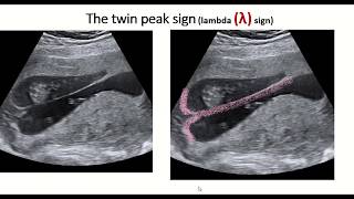 Twin peak sign or lambda sign  feature of dichorionic diamniotic twin pregnancy [upl. by Edd]