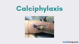 Calciphylaxis CUA [upl. by Yerffoj298]