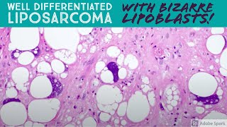 Well differentiated liposarcoma with BIZARRE pleomorphic lipoblasts 5Minute Pathology Pearls [upl. by Uahsoj]