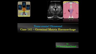 Ultrasound Case 141  Germinal Matrix Haemorrhage [upl. by Aikas]