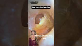 Eardrum Perforation [upl. by Samal]