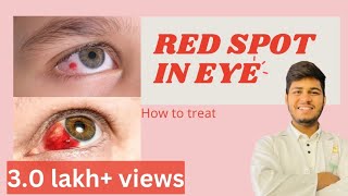 Blood spot in eye reasons How to treat blood spot in eye  Subconjunctival haemorrhage [upl. by Yunfei]