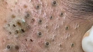 Big Cystic Acne Blackheads Extraction Blackheads amp Milia Whiteheads Removal Pimple Popping  2636 [upl. by Isabeau]