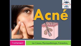 Quel Meilleur Traitement Pour l’Acné sévère du visage Méthode Laser Hormonale Naturel Antibiotique [upl. by Laiceps]