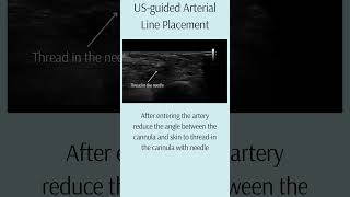 USguided Arterial Line Placement arteriallineciriticalcare USguidance [upl. by Annoek]