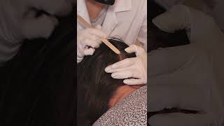 ASMR Examining Skin LESIONS on SCALP Real Person hair asmr short shorts [upl. by Onida202]