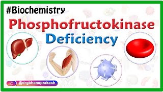 Phosphofructokinase deficiency Animation Tarui disease  GlycogenStorage Disease Type VII  USMLE [upl. by Anneiv]