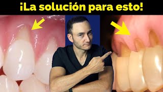 Retracción de encía y Desgaste en cuello de los dientes ¿Cómo se soluciona y qué lo provoca [upl. by Proffitt]