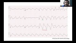 An ECG You Must Diagnose Immediately [upl. by Jory5]