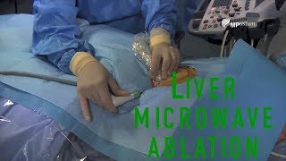 Liver microwave ablation of a sub capsular HCC with Ultrasound [upl. by Anagrom]