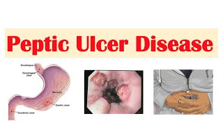 Peptic Ulcer Disease Gastric vs Duodenal Ulcers  Causes Symptoms Diagnosis Treatment [upl. by Brockie]