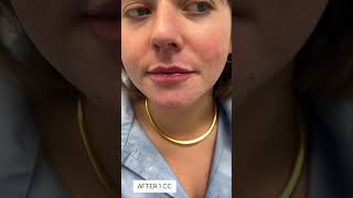 Lip fillers over time Skin Tightening Botox and Lip Fillers by Skinsation LA [upl. by Ainavi]