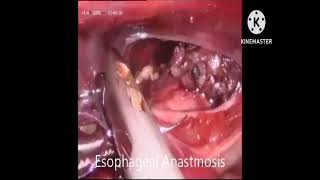 Thoracoscopic repair of Esophageal atresia with tracheoesophageal fistula [upl. by Mayhs728]