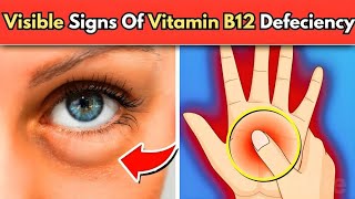 5 Visible Signs You Have Vitamin B12 Deficiency in 2024 [upl. by Nivag249]