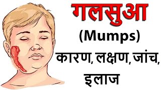 गलसुआ mumps कनफेड कण्ठमाला का रोग  क्या है क्यों होता है क्या खाना चाहिए बचाव कैसे करे [upl. by Salis]