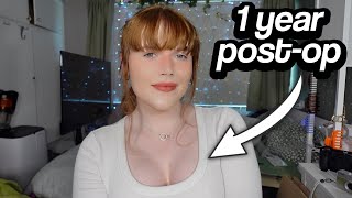 My Breast Augmentation Experience 1 Year Post Op MtF Transgender [upl. by Anole]