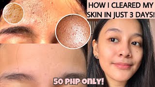 HOW TO GET RID OF TINY BUMPS ON FOREHEADFACE FAST  FUNGAL ACNE how i cleared my skin ENG SUB [upl. by Eecyaj]