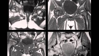 Osteocondrosis Osteocondritis Osteonecrosis Infarto Oseo Radiologia Radiografiaswmv [upl. by Entsirhc880]