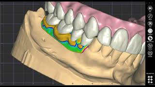 Milled ivotion denture teeth design on the frame [upl. by Saerdna]