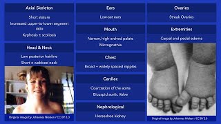 Turner Syndrome Dysmorphic Features [upl. by Llehctim717]