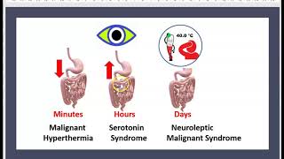 Le Syndrome Malin des Neuroleptiques Antipsychotiques Antidepresseurs Sérotonine Pharmacologie 3 mn [upl. by Connolly]